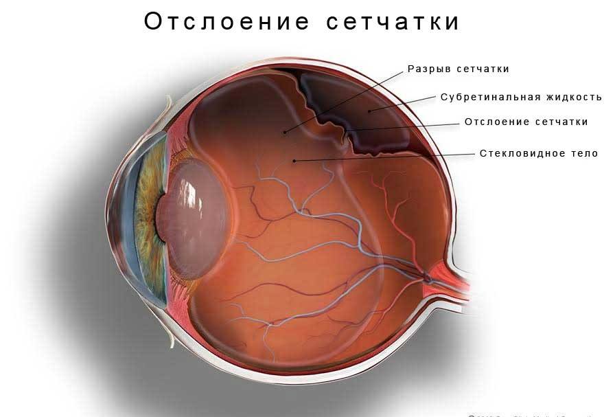 Отслаивание сетчатки Отслаивание сетчатки