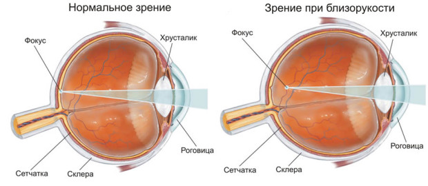 Близорукость Близорукость