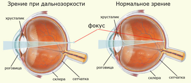 Дальнозоркость Дальнозоркость
